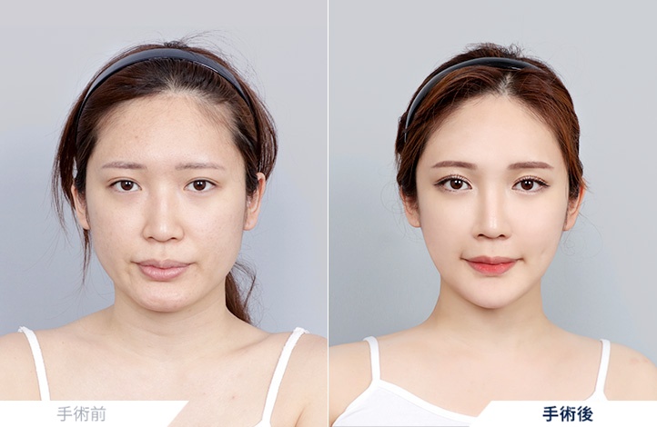 頬骨縮小+エラ削り+オトガイ形成+アキュスカルプ(二重顎)+鼻整形前後写真