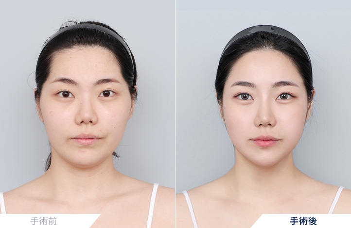 頬骨縮小+鼻整形+アキュスカルプ(フェイスライン+二重顎)+脂肪移植(額)前後写真