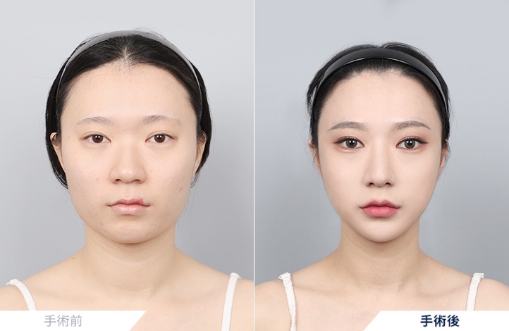 頬骨縮小+エラ削り+オトガイ形成+アキュスカルプ+鼻整形前後写真