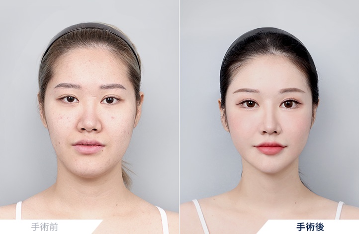 頬骨縮小+エラ削り+オトガイ形成+鼻再手術+脂肪移植(額,前頬)前後写真