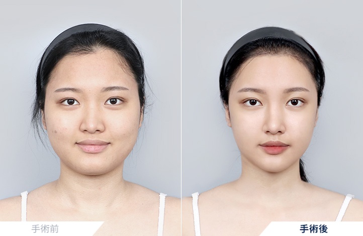 頬骨縮小+エラ削り+オトガイ形成+アキュスカルプ(フェイスライン+二重顎)+鼻整形前後写真