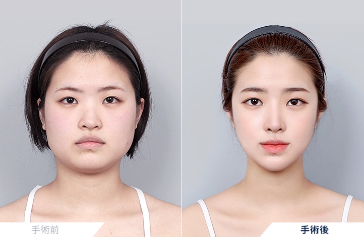 頬骨縮小+エラ削り+オトガイ形成+咬筋縮小+アキュスカルプ+鼻整形前後写真