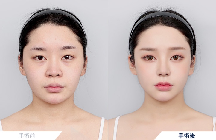 頬骨縮小+エラ削り+オトガイ形成+アキュスカルプ(フェイスライン+二重顎)+鼻整形前後写真