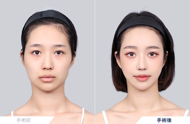 頬骨縮小+エラ削り+フルフェイス脂肪移植+鼻整形前後写真