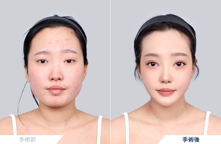 輪郭3点+目整形+アキュスカルプ前後写真