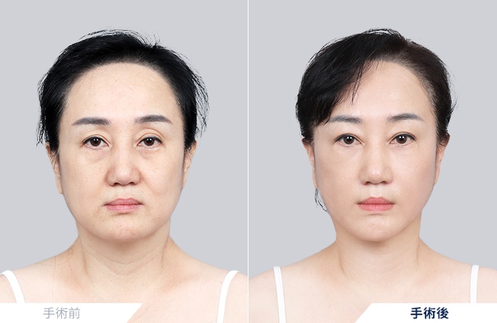 顔面挙上+首リフト+下眼瞼前後写真