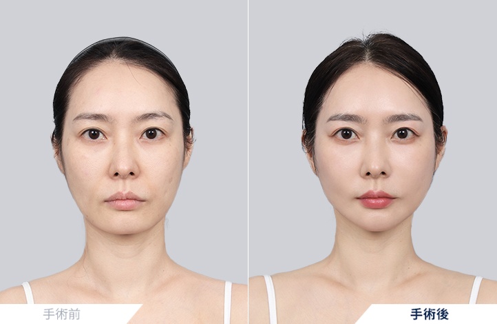 3D小顔輪郭術+フルミニリフト前後写真