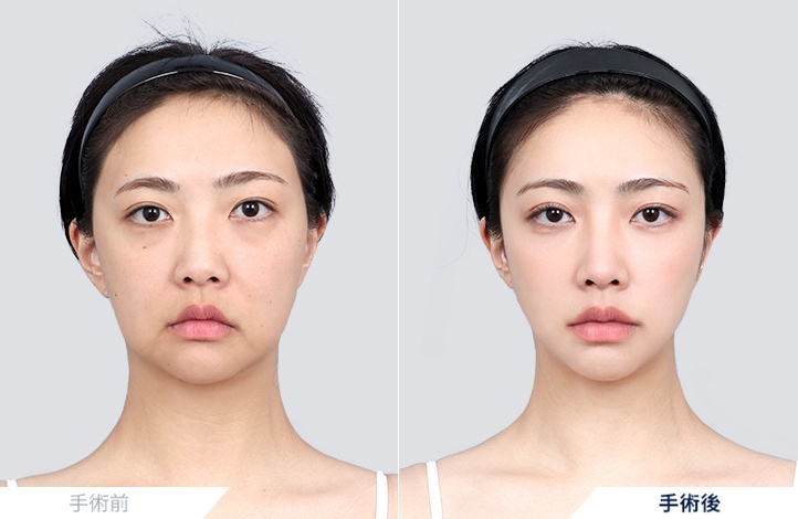 3D小顔輪郭術+ミニリフト前後写真