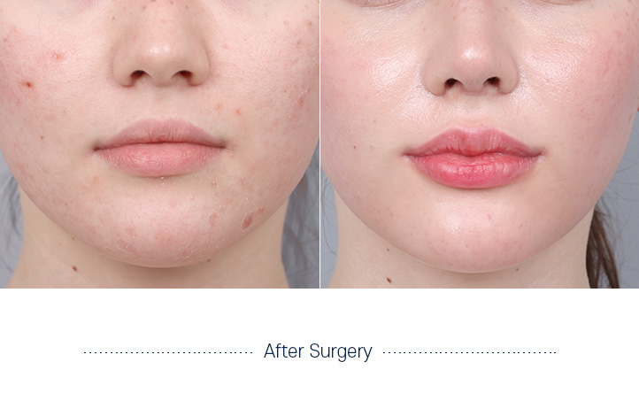 口角手術前後写真