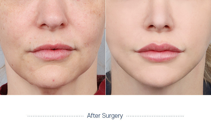 口角手術前後写真