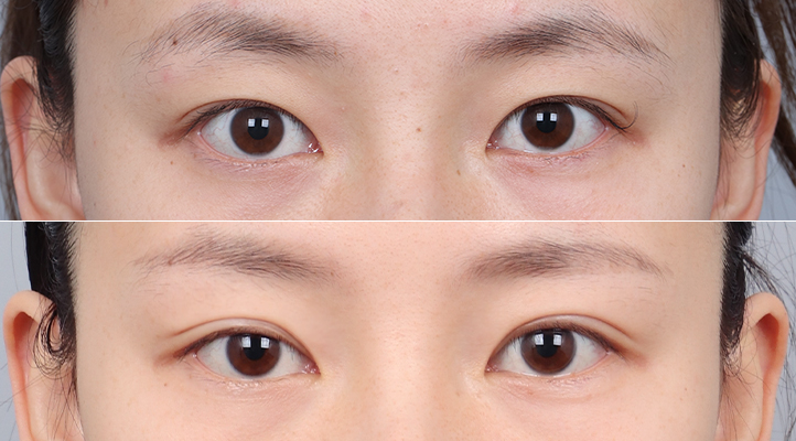 DA 二重整形前後写真