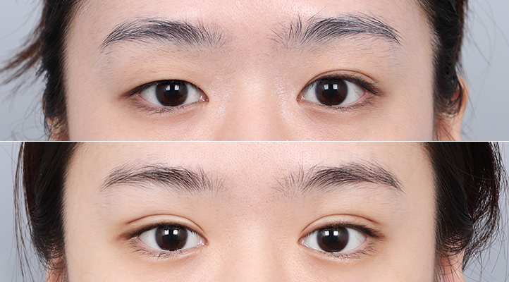 DA 二重整形前後写真