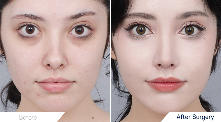 鼻整形前後写真