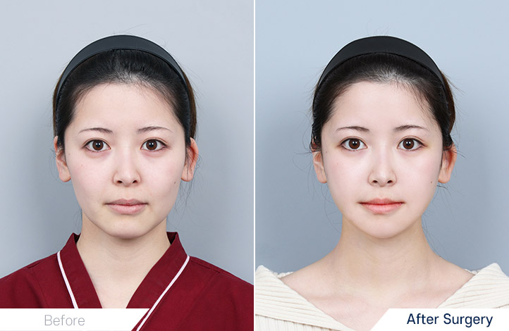 輪郭3点, アキュースカルフリフティング前後写真