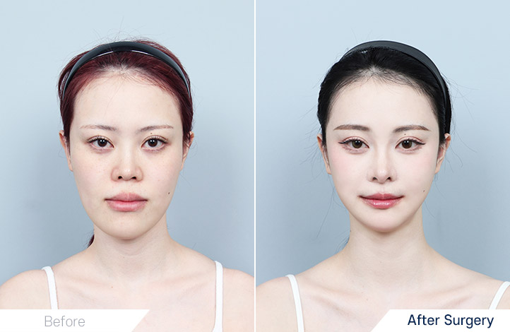 両顎手術, 輪郭3点前後写真