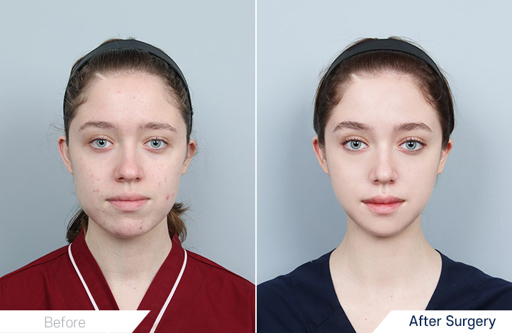 エラ削り, オトガイ形成前後写真