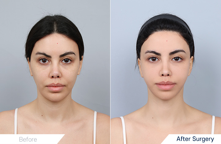 フル切開リフト, ネック挙上術, アキュースカルフリフティング前後写真