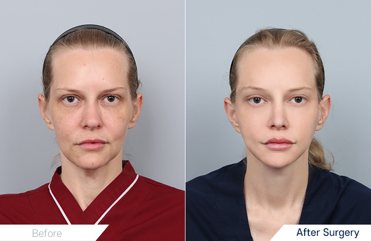 フル切開リフト, 口角手術, 脂肪吸引, 豊胸前後写真