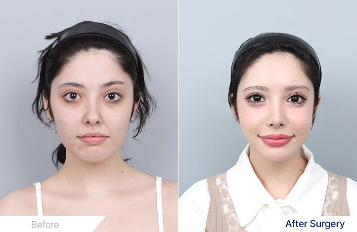 輪郭3点, 鼻整形, 輪郭手術, フル切開リフト前後写真