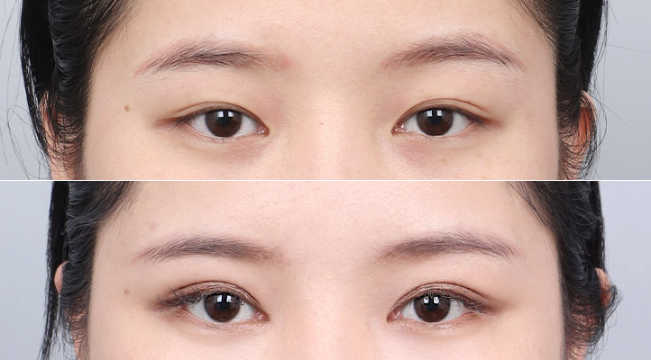 目整形, DA豊胸, アキュースカルフリフティング前後写真