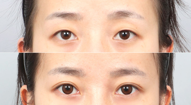 目整形前後写真