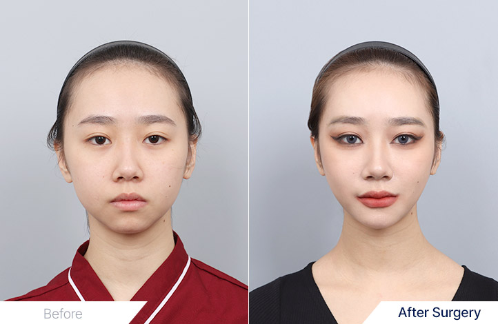 あごプロテーゼ挿入 前後写真