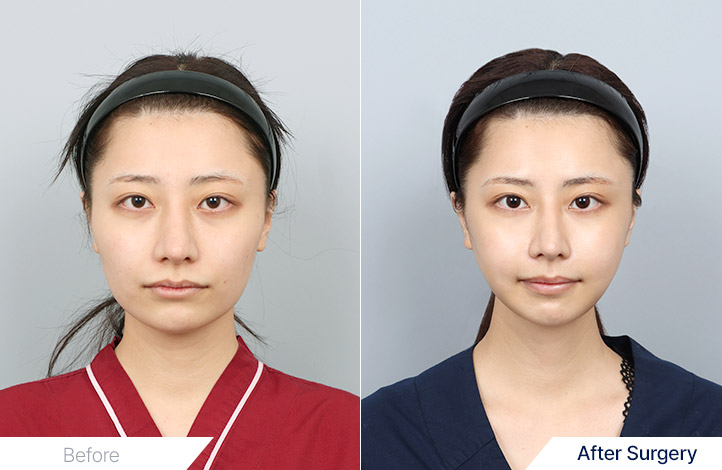 輪郭手術前後写真