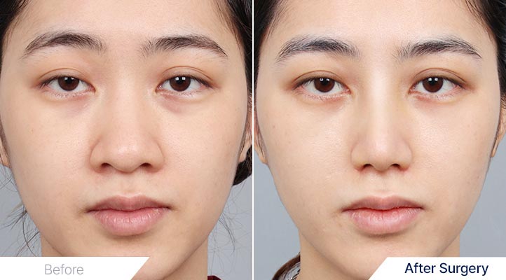 鼻整形前後写真