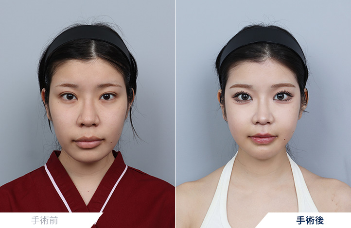 両顎手術, 顔面輪郭前後写真